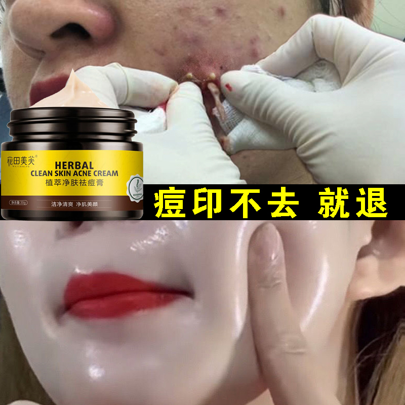 日本祛痘印痘疤痘坑男士淡化祛痘膏非粉刺修复神器女学生消去印炎