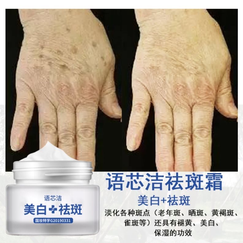 正品祛斑霜去斑的药淡斑女去手上老年斑去除专用手背手部脸部神器